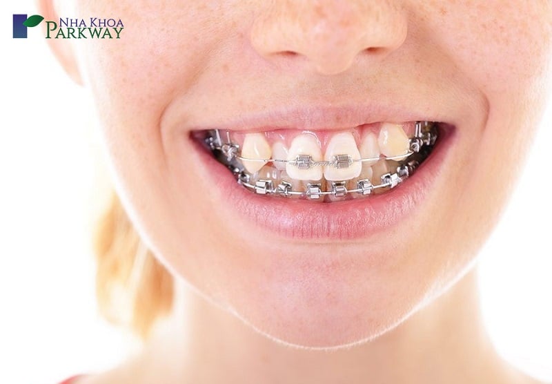 Niềng răng chính là phương pháp để khắc phục tình trạng răng khểnh 2 bên