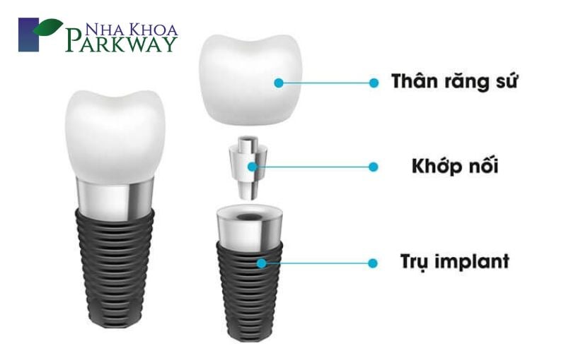 Hình ảnh cấu tạo của một chiếc răng implant