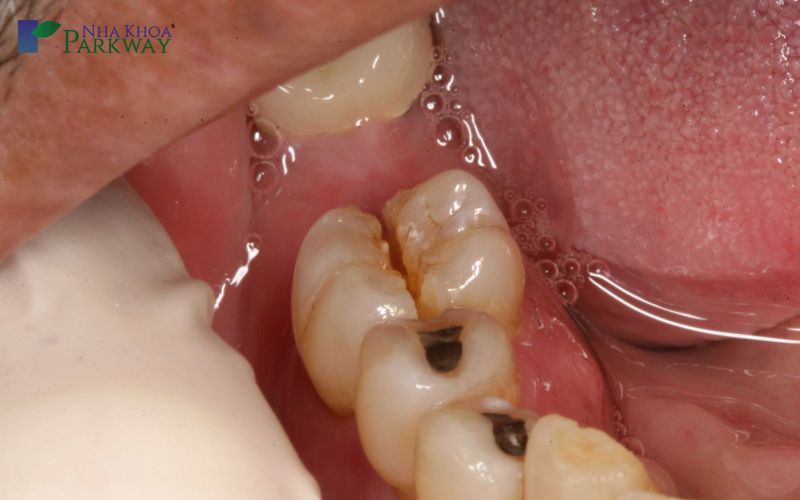 Răng khôn bị sâu vỡ đâm vào răng số 7 khiến chiếc răng dễ lung lay