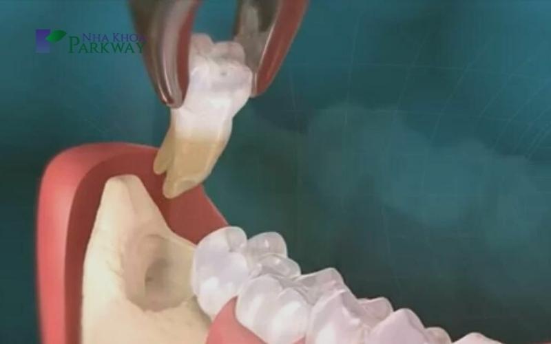 Răng khôn bị sâu phải làm sao – Có nên nhổ răng không