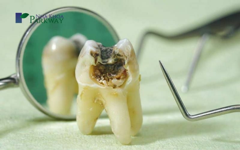 Hình ảnh răng bị sâu và lộ ngà răng