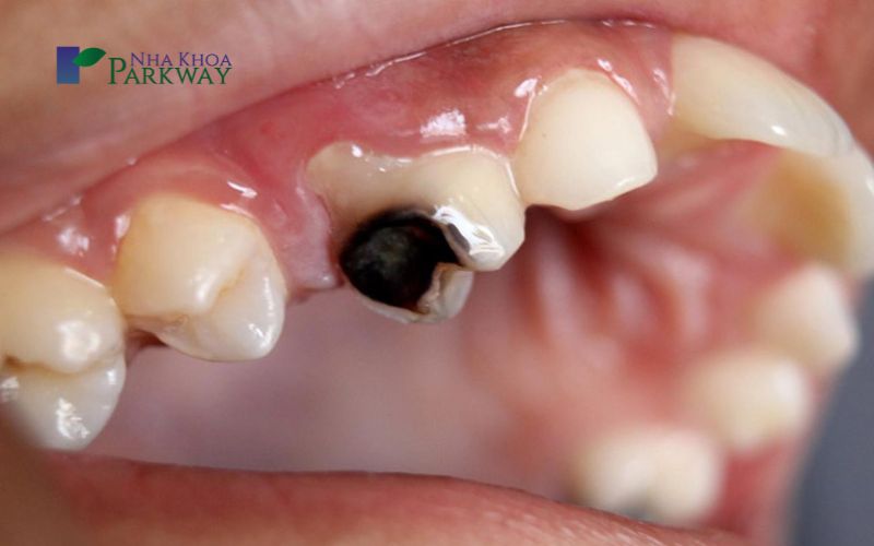Răng bị lộ ngà mang lại nhiều hậu quả về sức khỏe răng miệng
