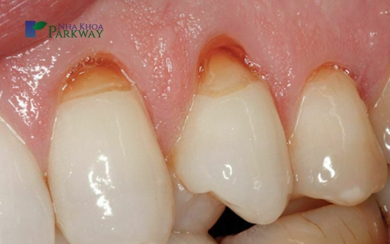 Hình ảnh răng bị lộ ngà ở phần chân răng