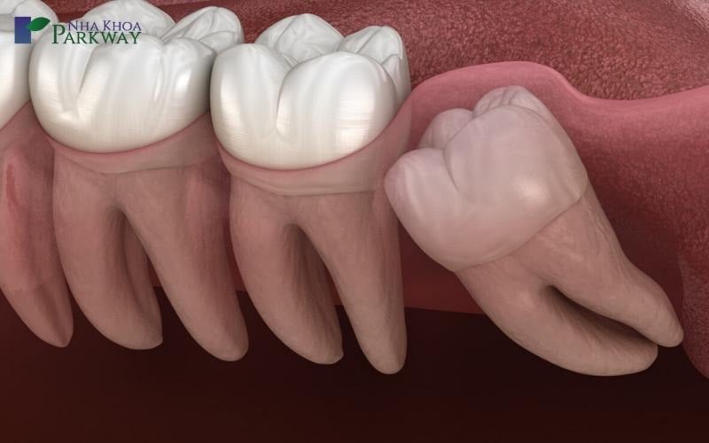 Hình ảnh minh họa răng mọc ngược trong nướu