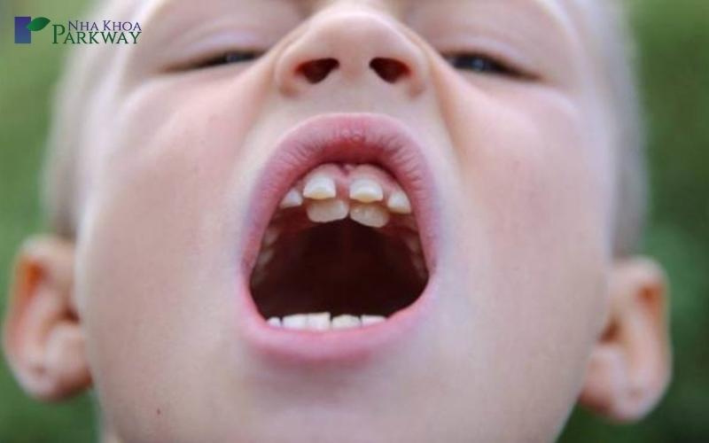 Hình ảnh răng mọc trên lợi ở trẻ em