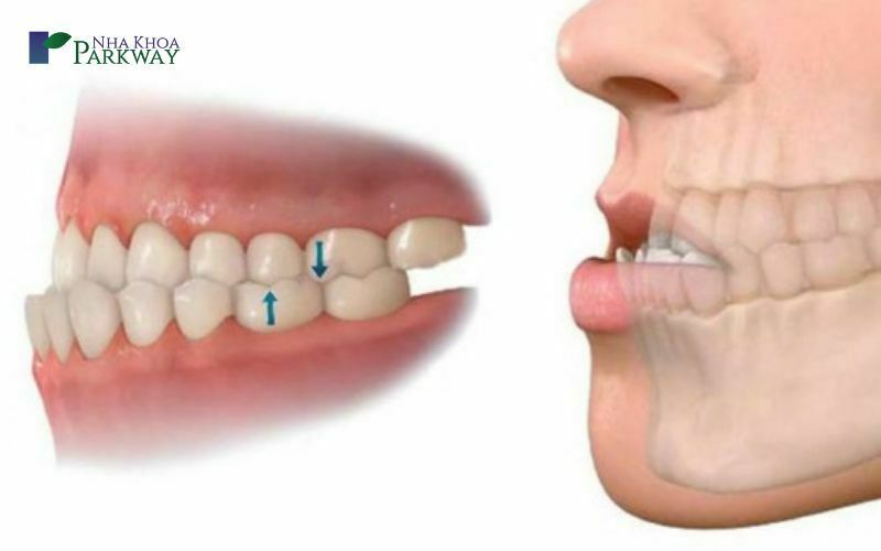 Hình ảnh mô phỏng tình trạng răng bị sai lệch do phía nhóm răng cửa dưới phát triển nhô ra ngoài