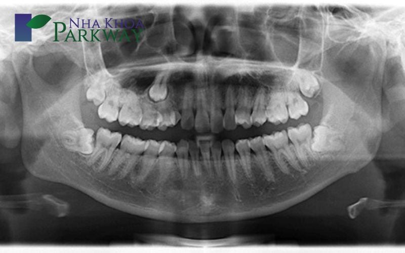 Ảnh chụp x-quang cho thấy răng số 3 nhọn mọc ngầm trong nướu