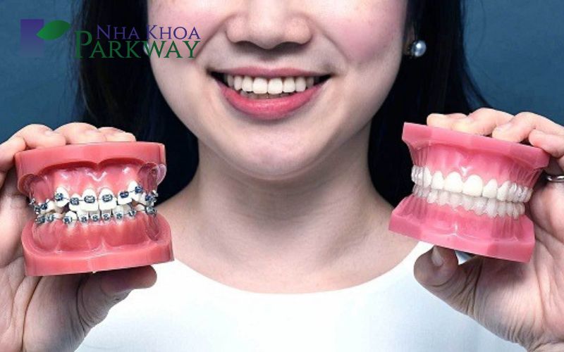 Mô hình hàm răng bình thường và niềng răng mắc cài kim loại