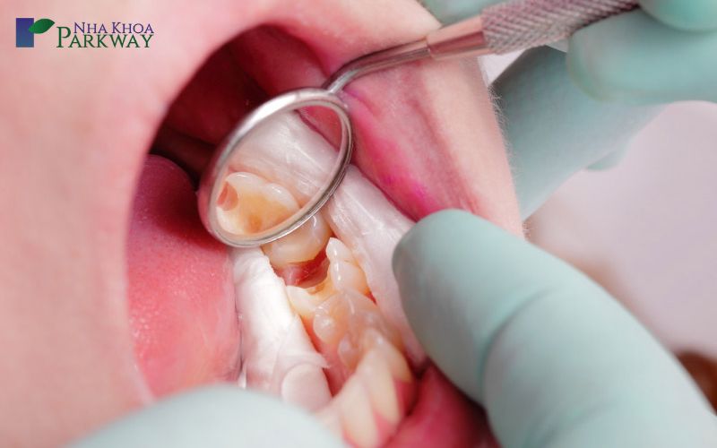 Cách điều trị răng sâu bị lồi thịt như thế nào?