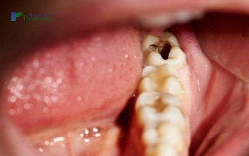 Những tác hại của việc răng số 8 bị sâu vỡ