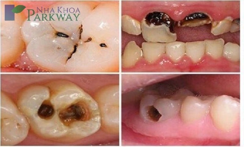 Hình ảnh sâu răng viêm tủy