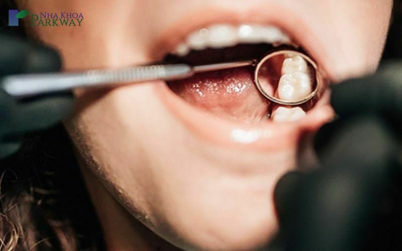 Sử dụng gương và dụng cụ y khoa chuyên dụng để kiểm tra răng