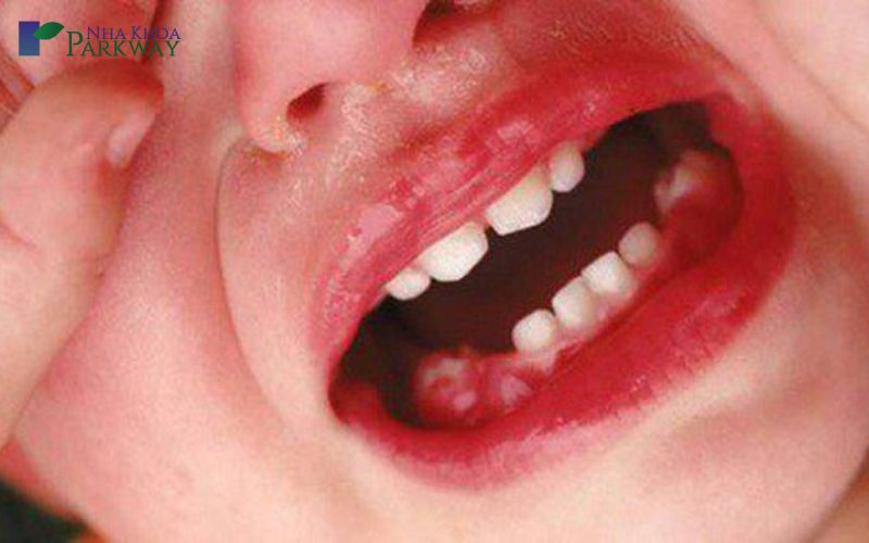 Hình ảnh em bé bị đau khi cha mẹ tự nhổ răng tại nhà