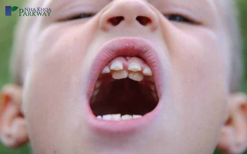 Cậu bé có răng vĩnh viễn bị mọc lệch do răng sữa không được nhổ