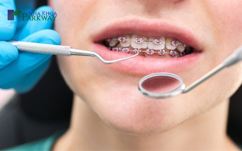 Sử dụng gương và dụng cụ nha khoa để điều chỉnh niềng răng mắc cài kim loại