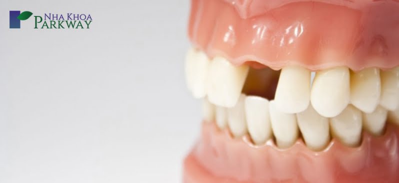 Những nguyên nhân làm cho răng bị gãy