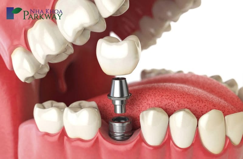 Bị rụng răng điều trị như thế nào tại nha khoa