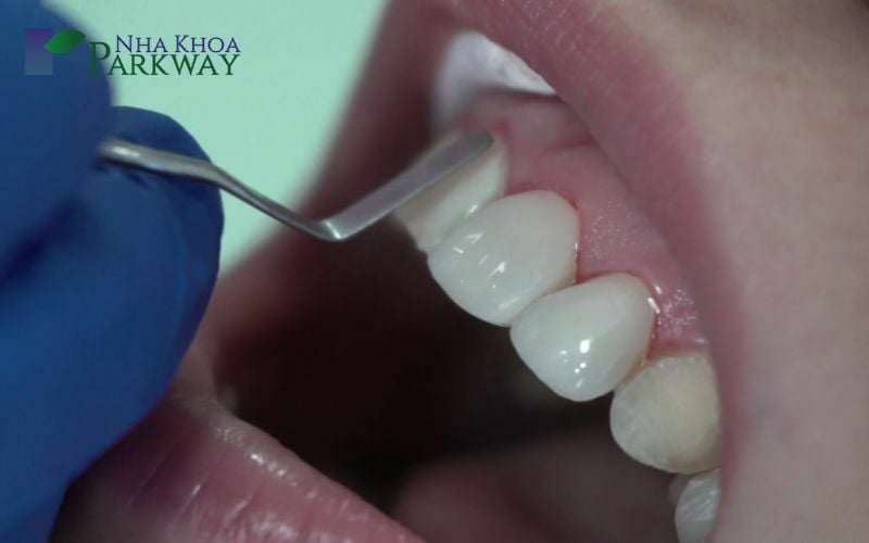 Sử dụng công cụ nha khoa để kiểm tra răng trước khi trám