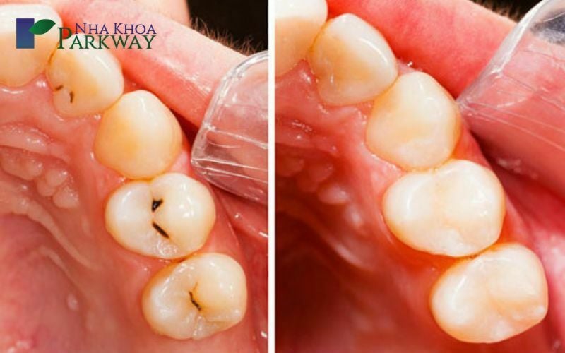 Hình ảnh của răng trước và sau khi trám