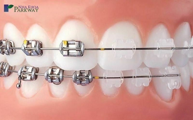 So sánh niềng răng mắc cài kim loại (trái) và mắc cài sứ (phải)