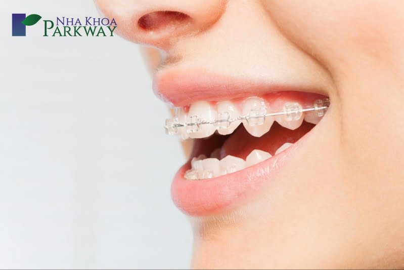 Phương pháp chỉnh sửa răng hô niềng răng