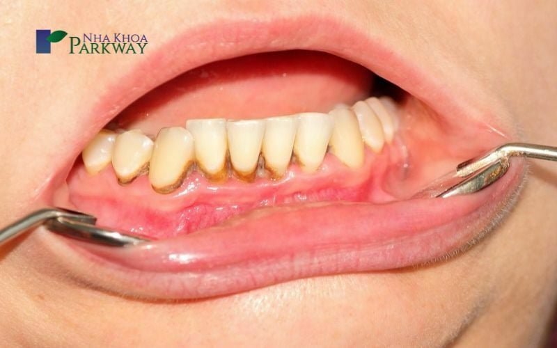 Hàm răng có nhiều cao răng bám ở chân và kẽ răng 