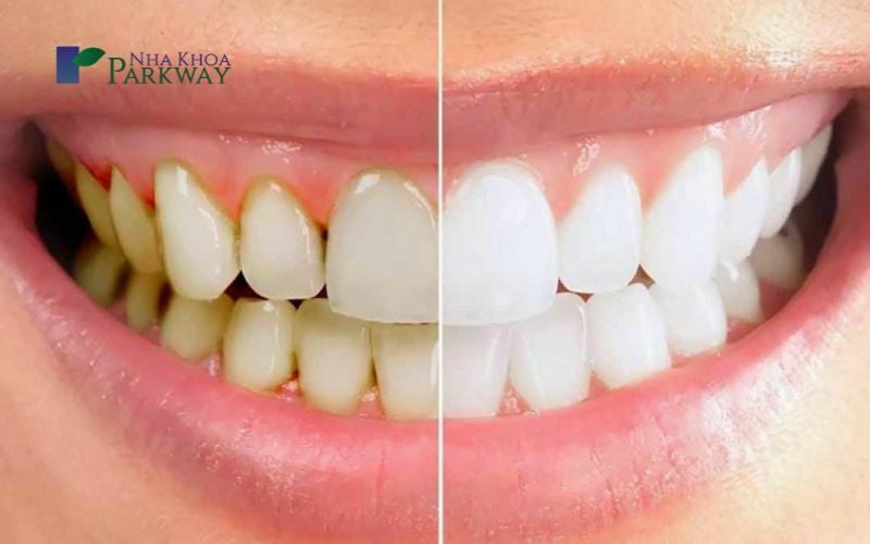 Hình ảnh răng trước và sau khi lấy cao