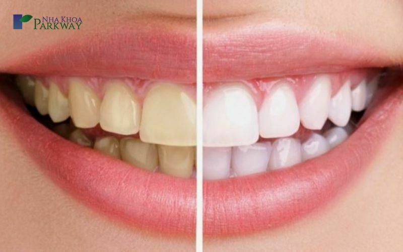 So sánh kết quả trước và sau khi sử dụng bột trắng răng Eucryl