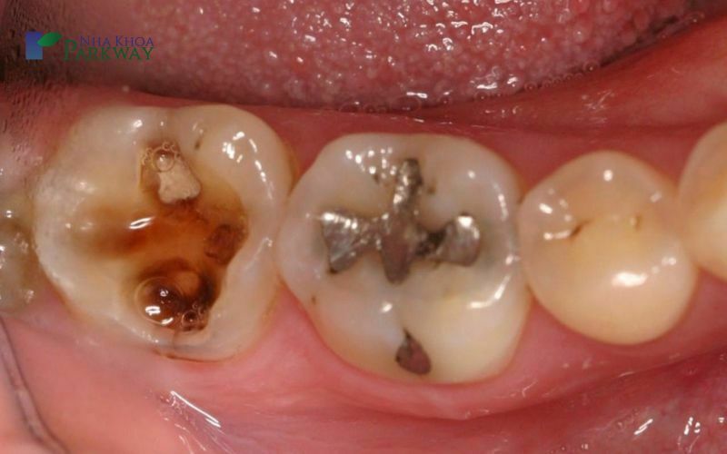 Trám răng sâu có đau không? Những lợi ích của trám răng sâu 