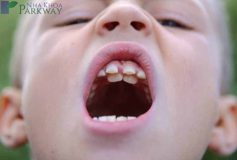 Răng cửa hàm trên mọc ngược vào trong