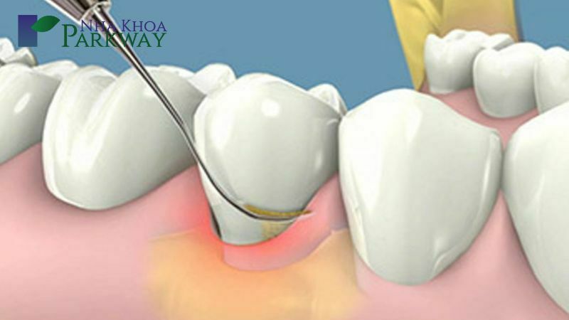 hình ảnh mô phỏng quá trình lấy cao răng