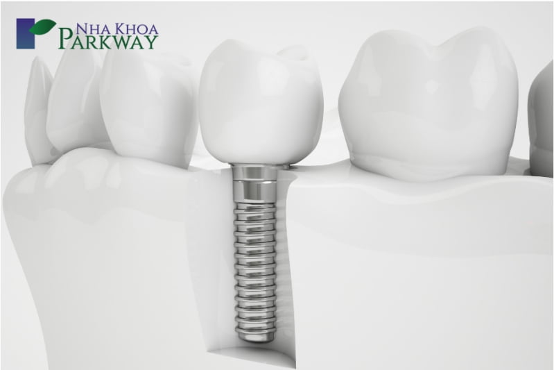 Trồng răng giả bằng phương pháp cấy ghép Implant mất bao lâu?