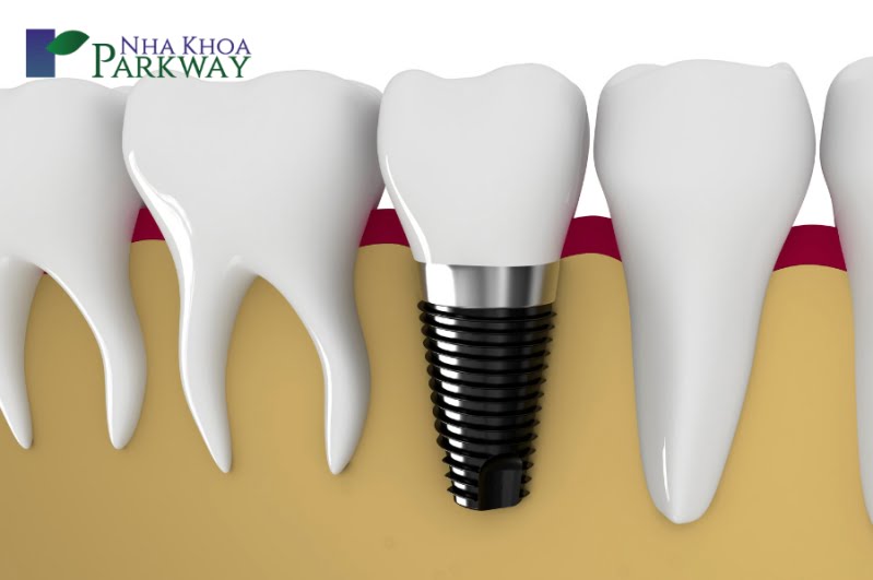 Vì sao trồng răng giả vĩnh viễn Implant lại bền hơn những phương pháp trồng răng khác?