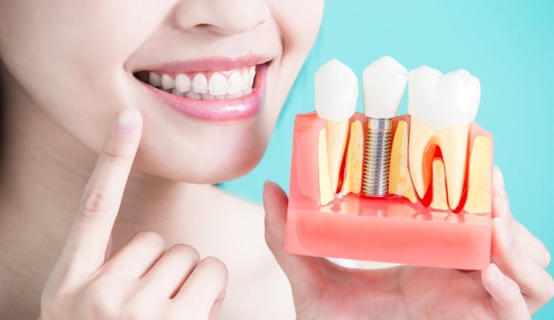 Hình ảnh cô gái đang cười và cầm mô hình trồng răng implant