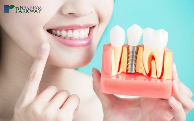 Quy trình trồng răng nguyên hàm bằng trụ implant diễn ra như thế nào?