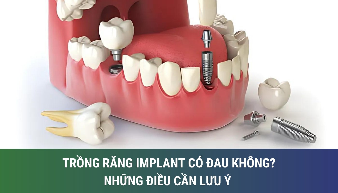 trồng răng implant có đau không? những điều cần lưu ý