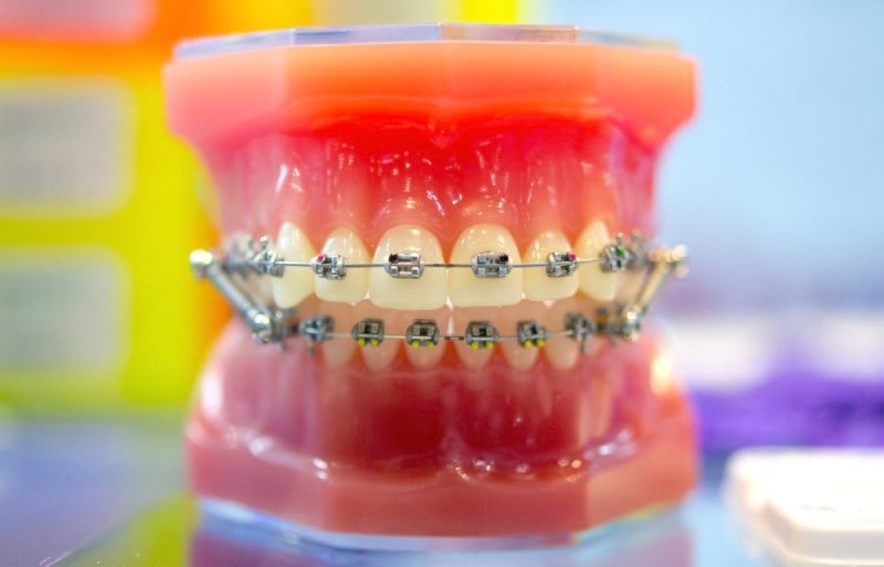 Mô hình hàm được niềng răng bằng phương pháp mắc cài kim loại
