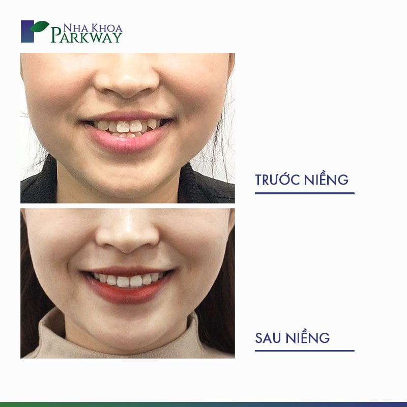 Hình ảnh trước và sau niềng răng