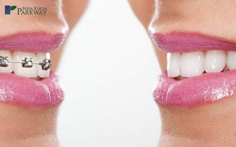 So sánh hàm răng trước và sau khi niềng răng mắc cài kim loại 