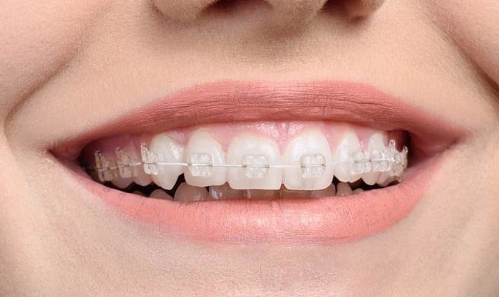 ưu điểm niềng răng mắc cài