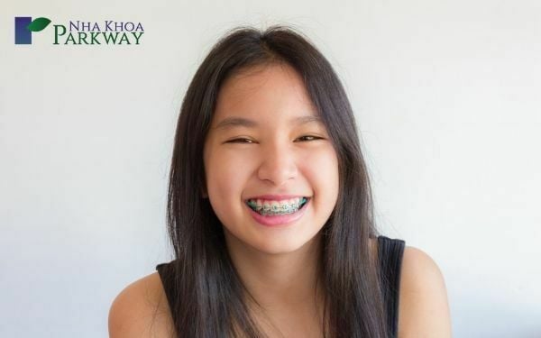 Cô bé cười tươi rạng rỡ với hàm răng được niềng bằng phương pháp niếng răng mắc cài kim loại
