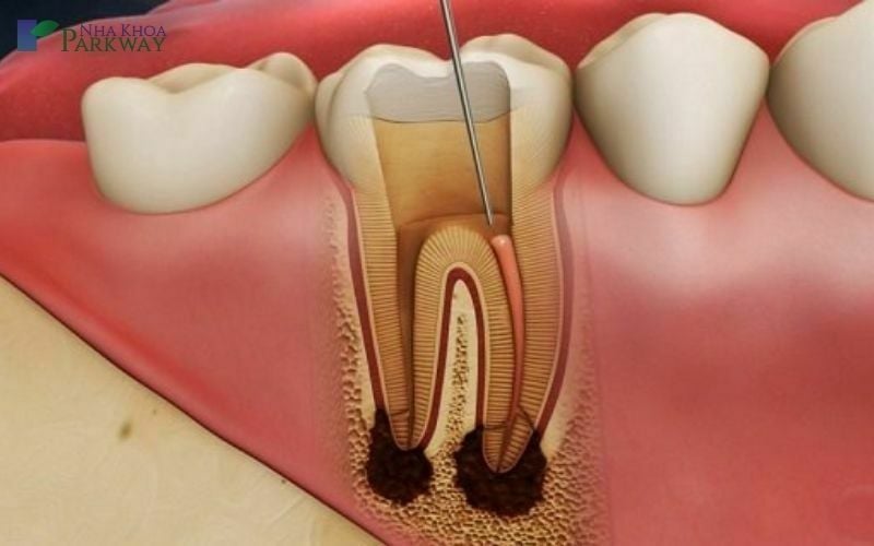 Mô phỏng sử dụng dụng cụ nha khoa để chữa viêm tủy răng