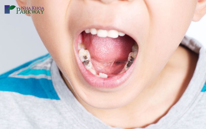 Hàm răng của trẻ bị sâu nhiều