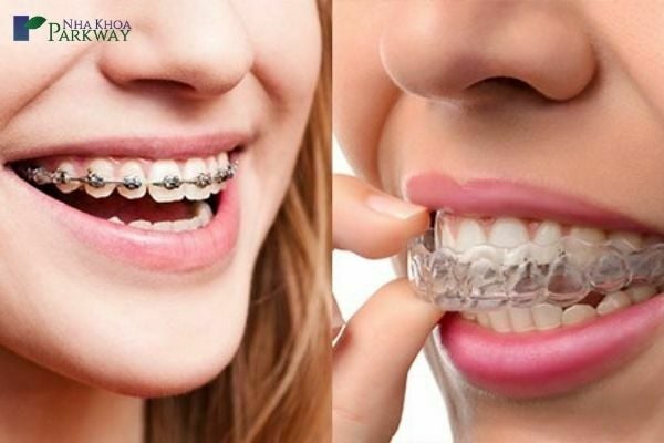 Hình ảnh so sánh giữa niềng răng mắc cài bên trái và niềng răng trong suốt