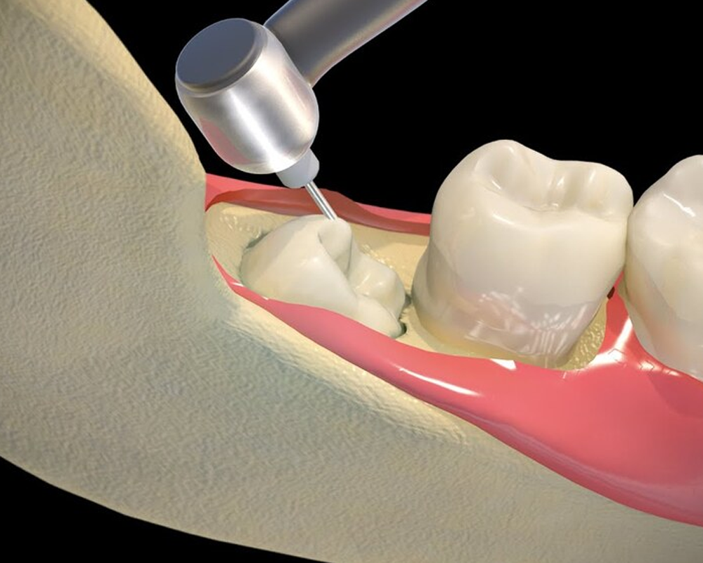 CHI PHÍ NHỔ RĂNG KHÔN TẠI BỆNH VIỆN RĂNG HÀM MẶT TRUNG ƯƠNG