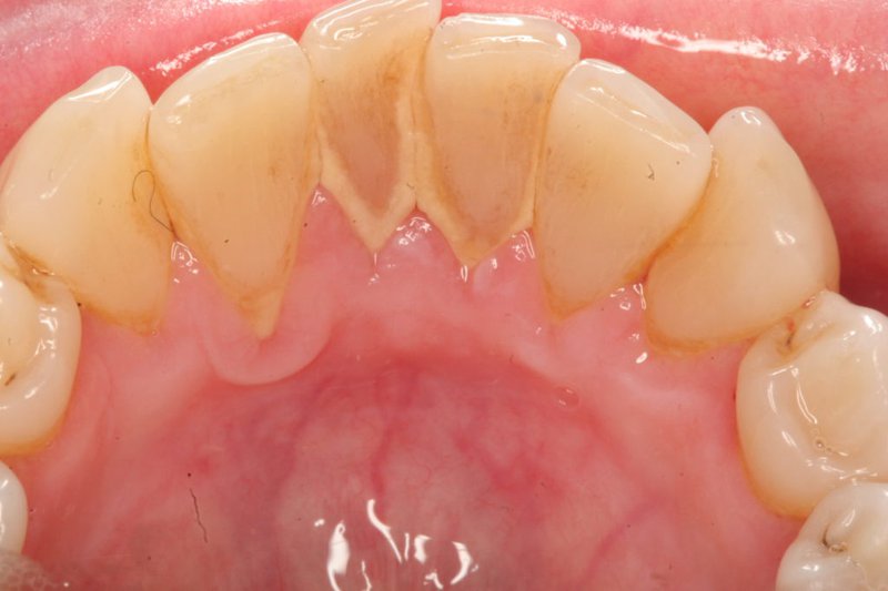 Hình ảnh mặt sau của hàm răng có nhiều cao răng cần làm sạch
