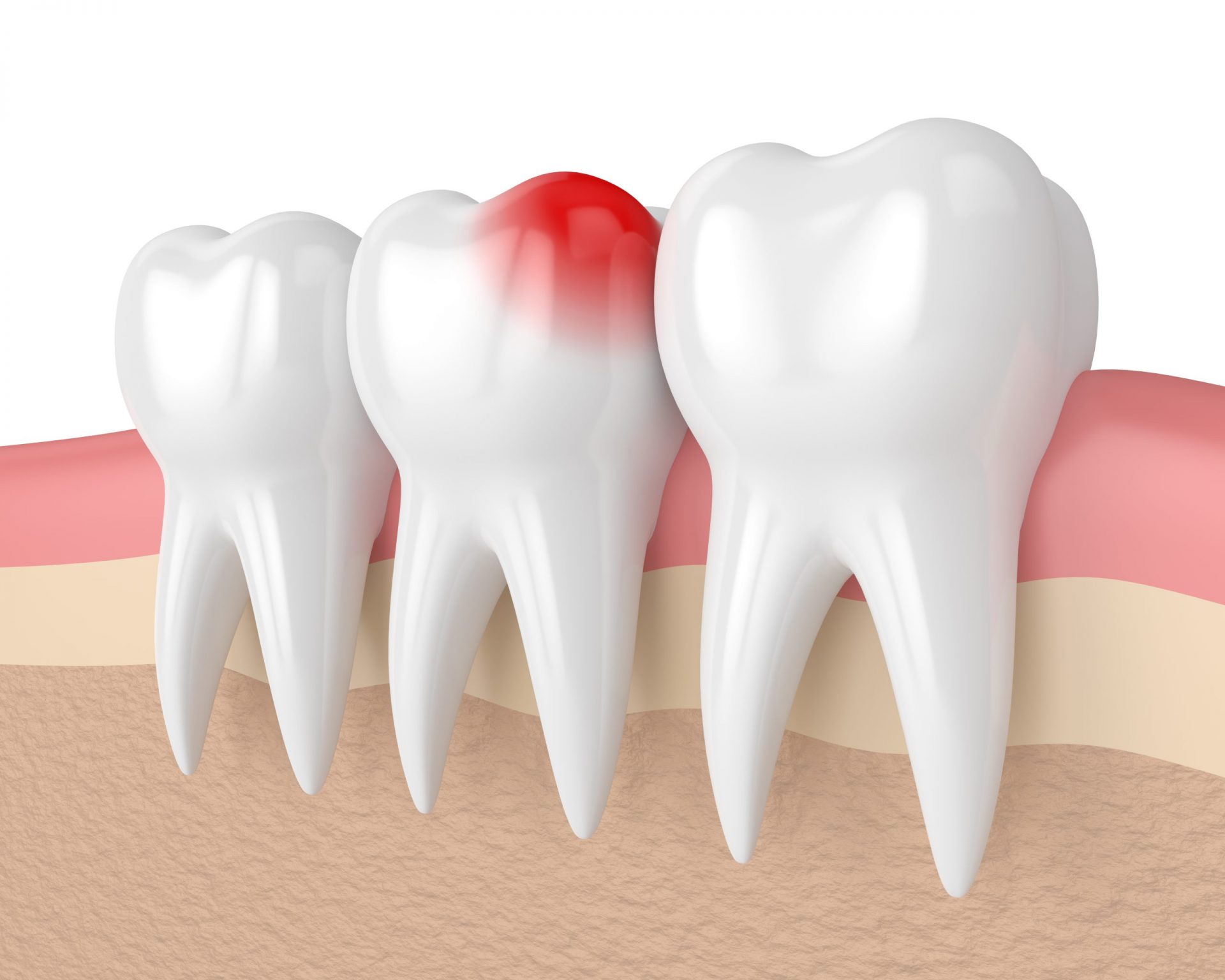 cách để răng khôn mọc thẳng