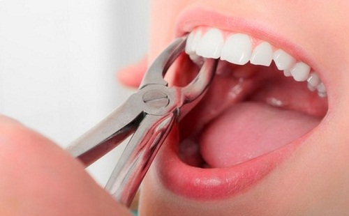 Hình ảnh cô gái đang được bác sĩ dùng kềm nha khoa nhổ răng