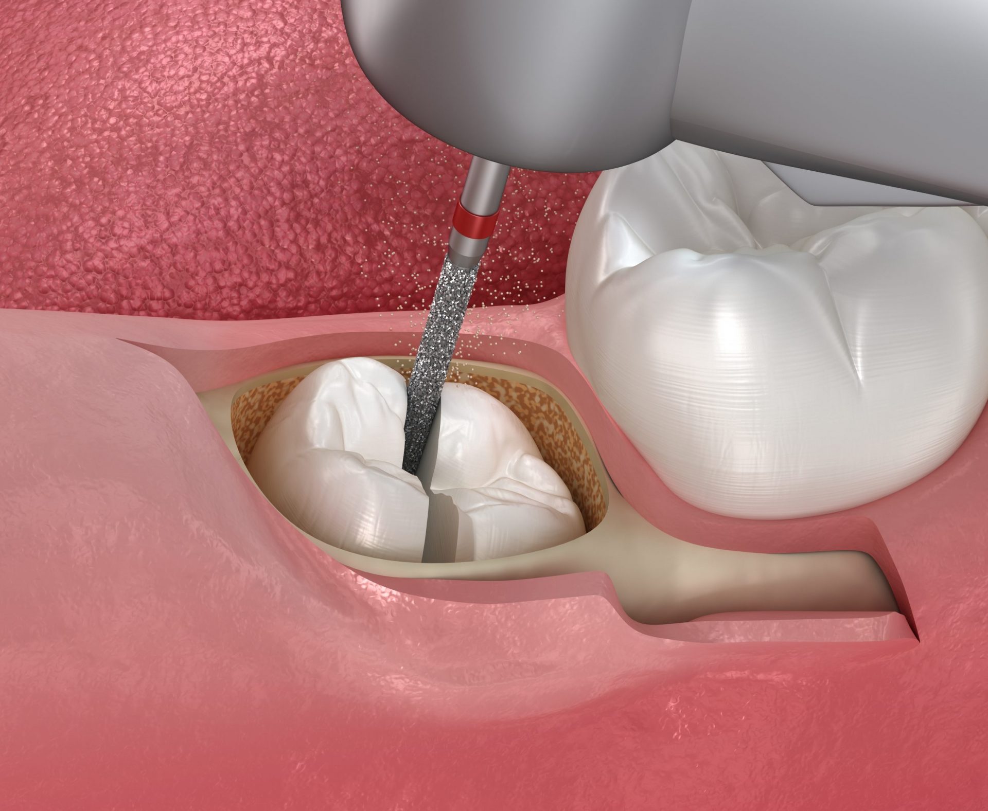 Hình ảnh bác sĩ đang tiểu nhẫu nhổ răng khôn mọc ngầm có mở xương, dùng máy khoan nha khoa để khoan lấy răng mọc ngầm