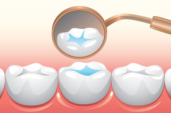 Sau khi trám răng bác sĩ kiểm tra lại bề mặt răng để đảm bảo chức năng ăn nhai tốt nhất